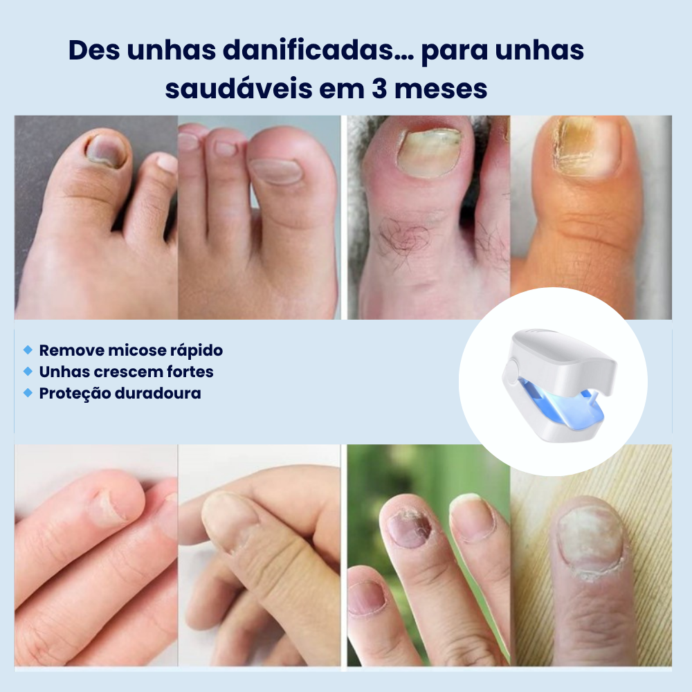 RenovaUnhas-Terapia de Luz Azul
